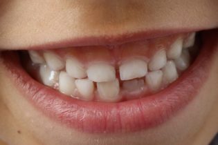 Comment calmer une rage de dents très facilement en pleine nuit ?